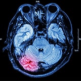 brain MRI